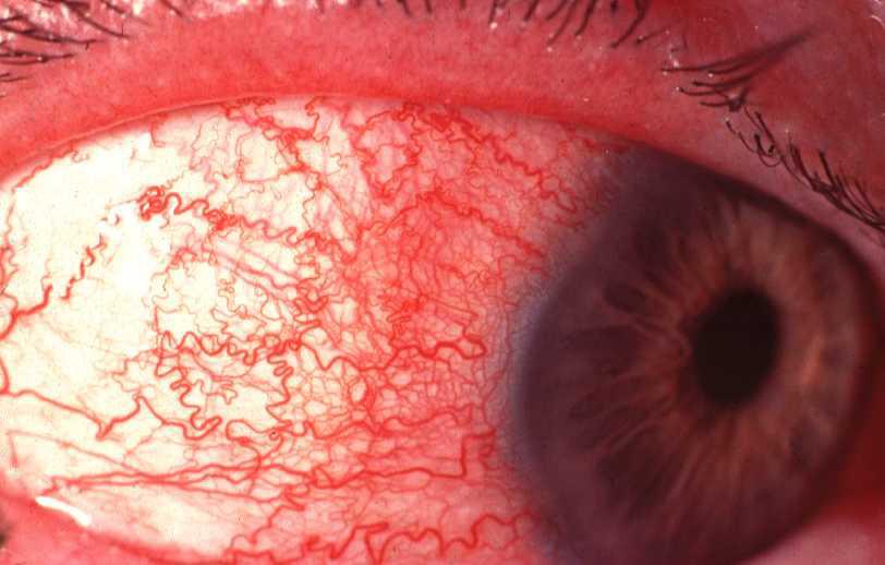 Acute anterior uveitis Majority are men 45% are positive for HLA-B27 Initially no systemic disease Minority