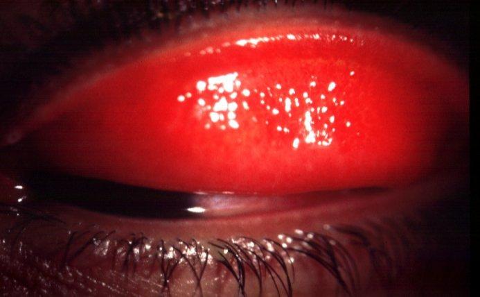 Viral conjunctivitis Usually bilateral, acute watery discharge