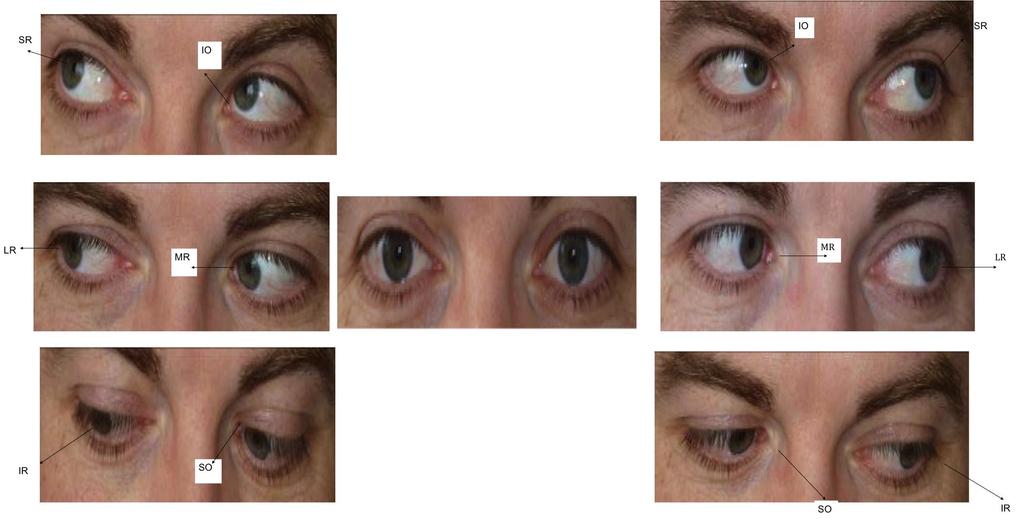 Extra ocular Muscle movement in all directions of gaze Each of the 6