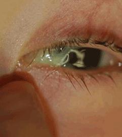 Lacrimal