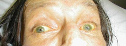 Sclera Yellow sclera (icterus): in liver or