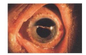 Iridodialysis Detachment of the iris root from the ciliary body Presentation: