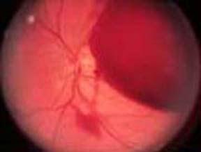 Pre-retinal Haemorrhage/ Vitreous Hge Visual acuity can be