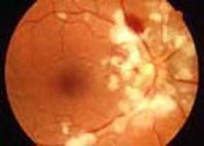 Purtscher's Retinopathy An injury that includes either : major chest compression (air bags) or head trauma Signs: cotton-wool spots and hemorrhages along the retinal arcades This diagnosis is driven
