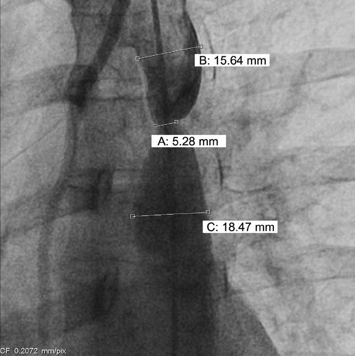Images of the aortic coarctation at the time of stent insertion.