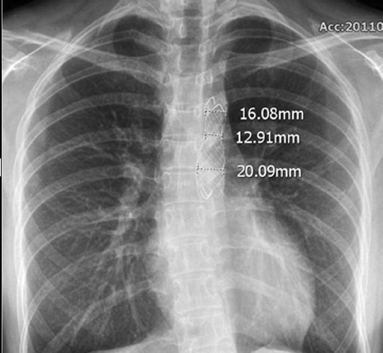 insertion 115/58/83 95/61/79 20 Cath Lab: Catheterization Laboratory, Asc Ao: ascending aorta, Dsc Ao: descending aorta mnant waist of the stent.