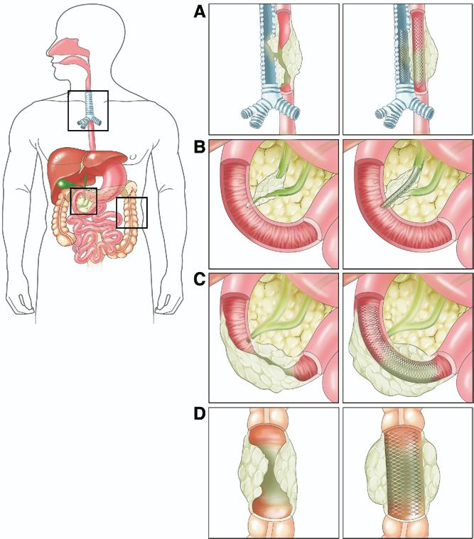 Figure 3. Closure of tracheoesophageal fistula. Endoscopic view: Immediately after placement of covered stent. Figure 1. Illustration of SEMS throughout the GI tract.