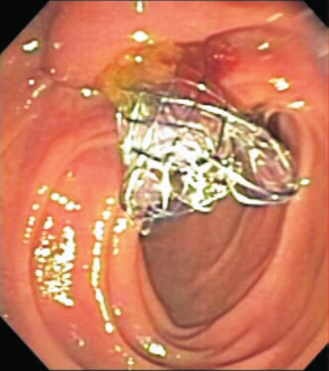 Figure 6. Fluoroscopic view of covered duodenal stent duodenum immediately after placement. Figure 5.