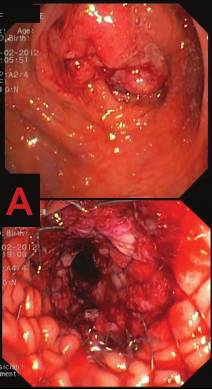 2 The Scientific World Journal (a) (b) Figure 1: Procedure for a nitinol SEMS placement in a 78-year-old man admitted because of intestinal occlusion due to colorectal cancer of the descending colon