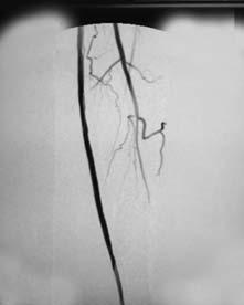 Figure 1: Pre-procedure angiogram showing an