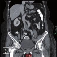 the left lower limb for two days. CT venography shows a descending thrombus from distal inferior caval vein to the distal external iliac vein (Figure 1).