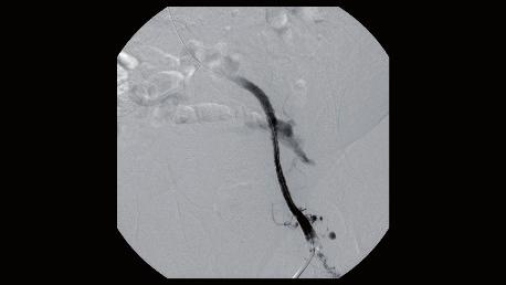 The first angiogram proved the complete thrombotic occlusion of the left iliac vein system (Figure 2).