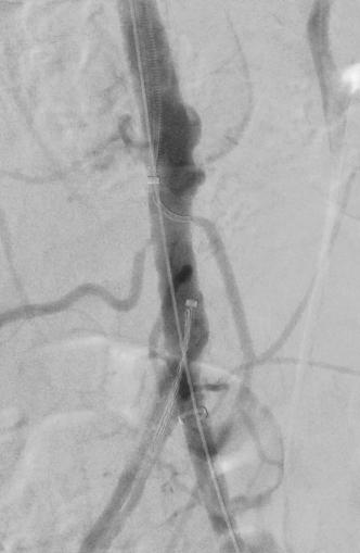 size (relative), cover collateral, cost Stent Grafts Endologix AFX : Heavy Aortic