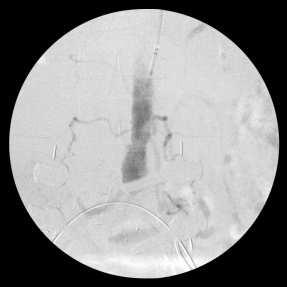 expandable: Ostial lesions, high radial force needed,