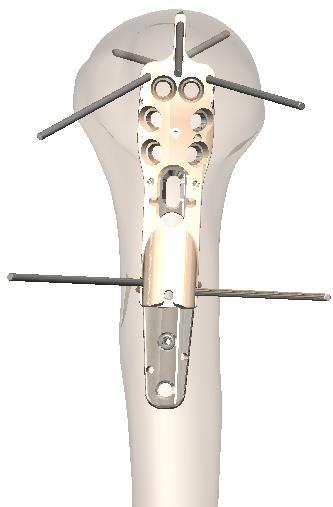 0mm K-wire should be directed toward the center of the humeral head in a lateral view. Confirm proper alignment of humeral head to humeral shaft.