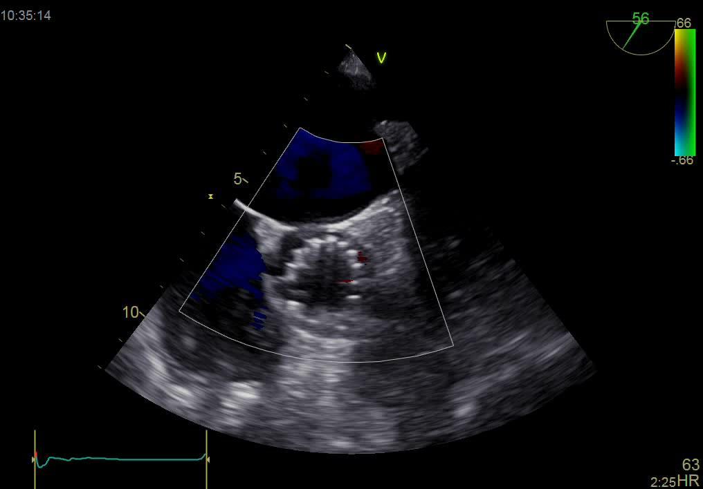 Bicuspid valve clinical example sizing/implantation technique