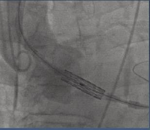 Aortic Root angulation Highly angulated aortic root anatomy vertical annulus or horizontal aorta can render TAVR implantation extremely challenging.