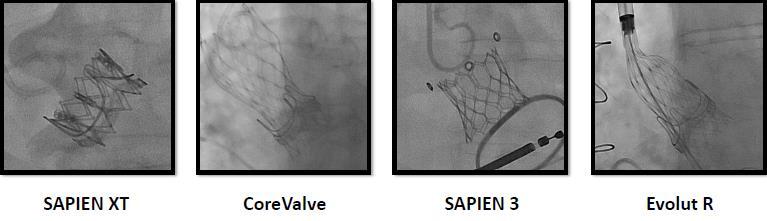 V-in-V In small surgical valves, a device with supra anular position (and with high implantation) is hemodynamically favored. In cases at risk for malposition (i.e. stentless) a repositionable THV is favored.