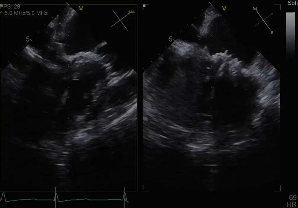 under the aortic valve Then deploy LV portion and