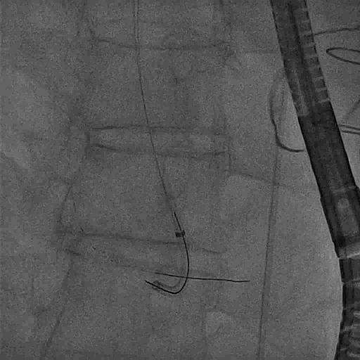 node Aortic Valve 2 aortic valve 3 right coronary artery 4 coronary