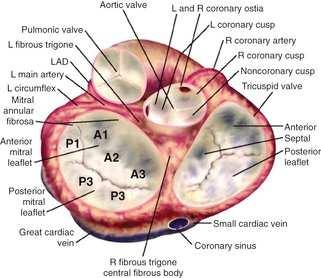 ? Pre-procedural Severity of AS, cusp anatomy, annular size, vascular access