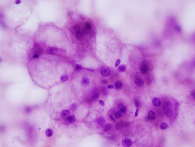 HCC, clear cell variant Pleomorphic HCC, multinucleation Immunochemistry: New