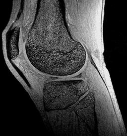 Knee MRI with IDEL SPGR SNR 20 10 0 Patellar Cartilage C Femoral Cartilage D groups, further improving the SNR efficiency of the technique.