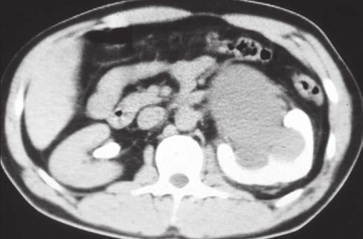 CT Urography Principles, Patterns, and Fig. 2 32-year-old man with absent left kidney (absent nephrogram).