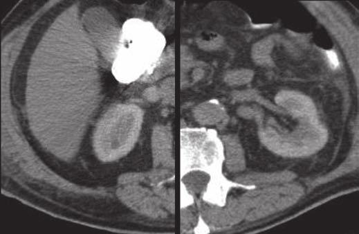 4 29-year-old man with distal ureteral obstruction. Unilateral hyperdense pattern is seen on nephrogram.