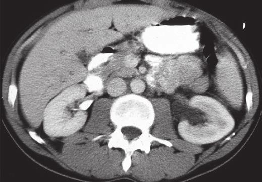Bilateral persistent or delayed pattern is seen on nephrogram.