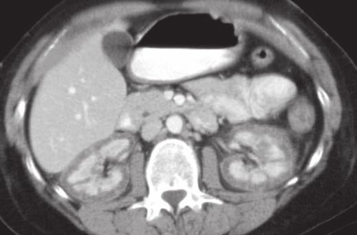 Note absence of contrast bolus in aorta. These findings are consistent with acute tubular necrosis. Fig.