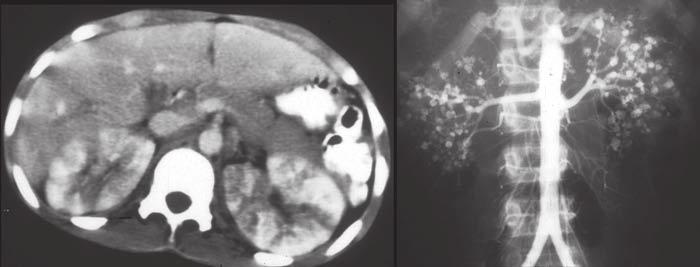 Spotted pattern is seen on nephrogram (left).