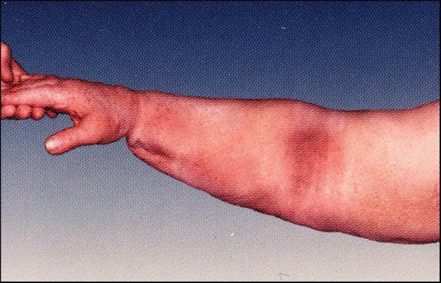 Why is Lymphedema a Problem?