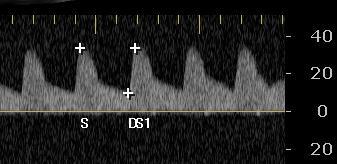 Flow pattern of anterior cerebral artery at > 12 hours of life in relation to