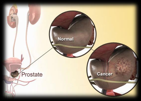 The first is termed benign prostatic hyperplasia (BPH). BPH results from the prostate growing larger but the growth is not cancerous.