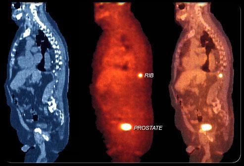 Prostate Cancer Staging Prostate cancer staging is a method that indicates how far the cancer has spread in the body and is used to help determine the best treatment method for the patient.