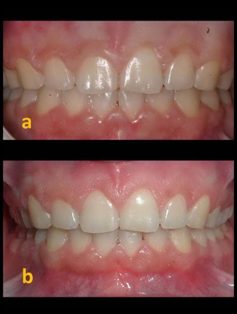 of the lateral incisors; 3) A line drawn horizontally at the level of the canine gingival margins should be parallel to the inter-pupillary line; 4) The smile should expose a minimal amount of