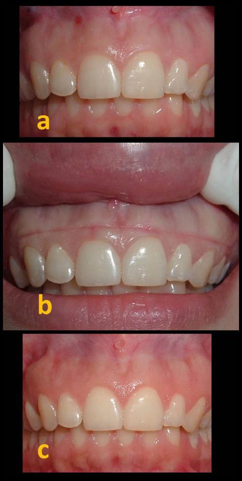 He also suggested that the crowns of central incisors and canines could be exposed to an overall length of 11 to 12 mm to attain maximal gingival reduction.