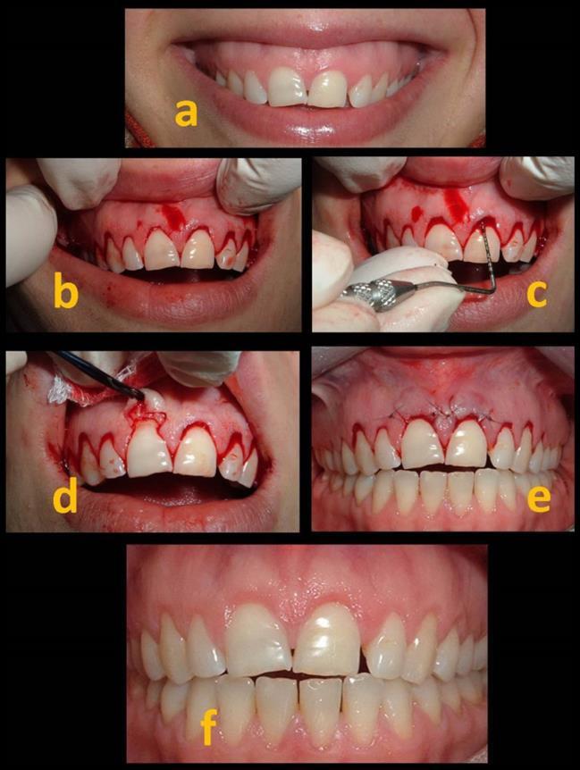 52 Esthetic crown lengthening Assaf M connecting the mesial and distal line angles of the adjacent teeth with horizontal incisions and without separating the tip of papilla from underlying bone (Fig.