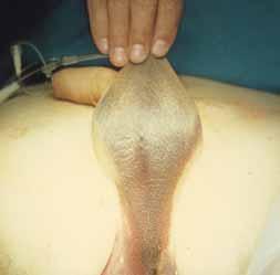 pass urine Palpable distended bladder Scrotal and/or