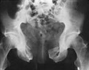 Imaging techniques 92% of male subjects with pelvic fracture and urethral injury had specific