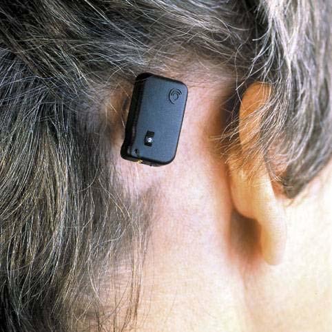 of patients with single sided deafness
