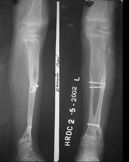 9%) Total Number of Surgical Intervention 112 12 years old girl with gap non union of tibia Huntington s transfer 1 st and 2 nd stage Results of procedures other than that related to decompression