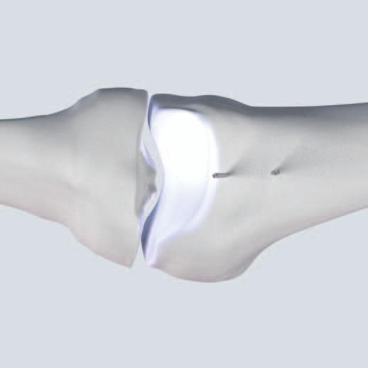 Osteotomy 4 Determine the position of the osteotomy Instrument 292.210 Kirschner Wire 2.