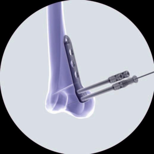 described above, so that the solid plate segment is bridging the osteotomy and the implant shaft is aligned parallel to the femoral shaft.