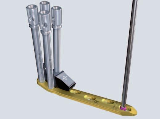 0 mm, length 2 mm, Titanium Alloy (TAN) To allow uniform orientation the four combination holes in the proximal shaft are numbered 1 4 and the four plate holes in the distal segment labelled A - D.