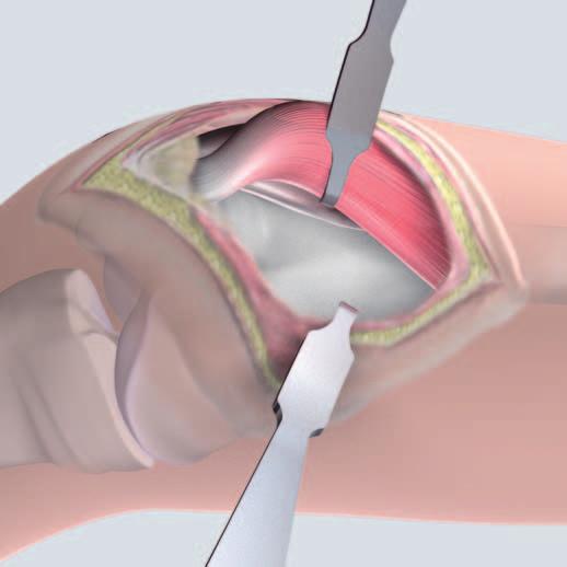 3 Approach With the knee joint in extended, position, an anteromedial longitudinal incision is made, starting 10 cm above the patella and ending in the upper third of the patella.