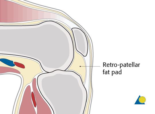 SITE OF SKIN INCISION AND ENTRY POINT Skin incision Make a longitudinal skin incision from lower pole patella to the tibial tuberosity. The incision is centered over the patellar ligament.