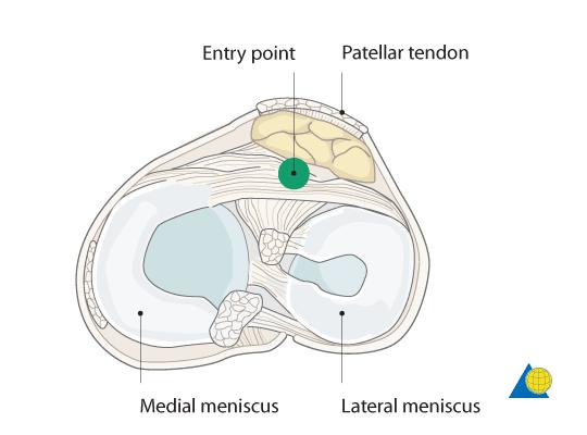 SITE OF SKIN INCISION AND ENTRY POINT DETERMINATION OF THE ENTRY POINT The nail entry point, on the lateral view, varies depending on nail design.