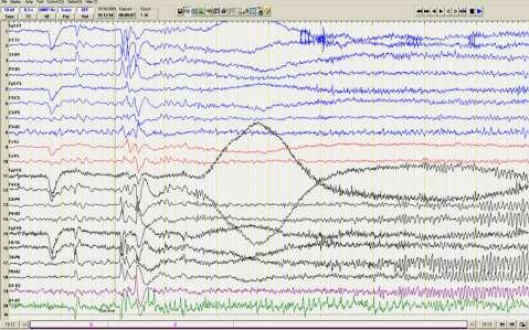 Ictal EEG